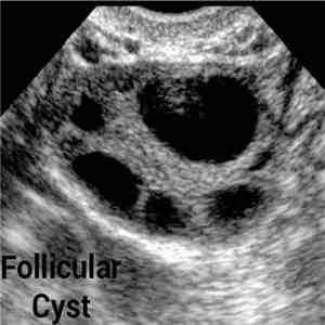 Follicular Cyst - Follicular Cyst