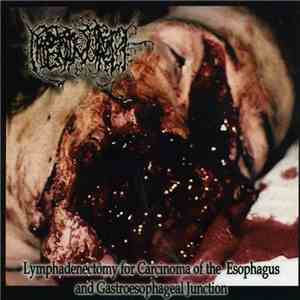 Hipermenorrea - Lymphadenectomy For Carcinoma Of The Esophagus And Gastroesophageal Junction